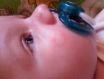 Ребенку 3 месяца пятно на щечке фото 2