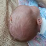 Образование на голове у новорожденного фото 3