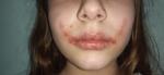 Болячки у ребенка на губах фото 1