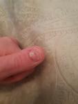 Грибок ногтя на большом пальце руки фото 1