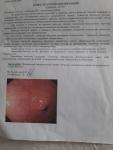 Фаволярная гиперплазия слизистой антрального отдела желудка фото 2