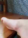 Воспаление на ноге фото 2