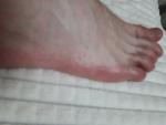 Сыпь и покраснение на ступнях и пальцах ног фото 1