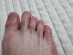 Сыпь и покраснение на ступнях и пальцах ног фото 2