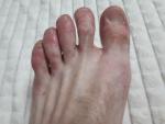 Сыпь и покраснение на ступнях и пальцах ног фото 4