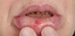 Как лечить припушлость на нижней губе? фото 1