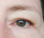 Воспаление глаза с пленкой фото 2