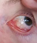 Воспаление глаза с пленкой фото 3