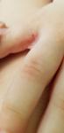 Сыпь между пальцев у ребенка фото 1