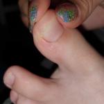 Пузырьки на большом пальце ноги фото 2
