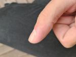 Воспаление на большом пальце руки около ногтя фото 2