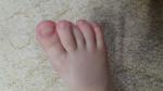 Искривление третьего пальца на ноге у ребенка фото 2