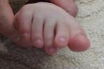 Искривление третьего пальца на ноге у ребенка фото 1