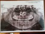 Перелом нижней челюсти фото 2