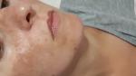 Пигментные пятна на лице после косметолога фото 2