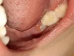 Режется зуб фото 1
