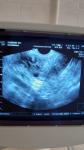 Подозрение на внематочную беременность. ХГЧ меньше 1 фото 1