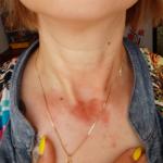 Аллергия, высыпания на коже фото 1