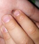Высыпания у ребенка на пальцах рук и локтях фото 1