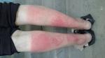 Высыпание на ногах от солнца или аллергия фото 2