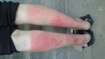 Высыапание на ногах от солнца или аллергия фото 1