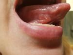 Болещненное воспаление сбоку языка фото 2