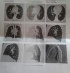 Почему пои астме смешанного генеза КТ установило диагноз хр. Бронхит? фото 1