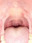 Воспаленное горло и проблемы с венами фото 5