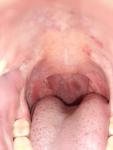 Воспаленное горло и проблемы с венами фото 4