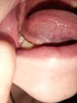 Воспаленное горло и проблемы с венами фото 3