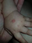 Пятно у ребенка на руке фото 1