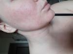 Проблема с кожей на щеках фото 2
