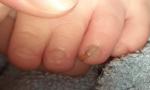 Нарост под ногтем и деформация ногтевой пластины фото 1