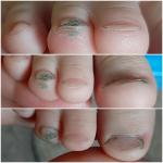 Нарост под ногтем и деформация ногтевой пластины фото 3