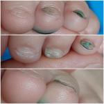Нарост под ногтем и деформация ногтевой пластины фото 4