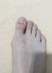 Воспаление вокруг большого пальца ноги фото 1