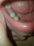 Болит зуб после установки штифта, неприятное ощущение фото 2
