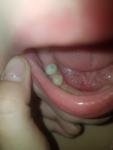 Болит зуб после установки штифта, неприятное ощущение фото 1