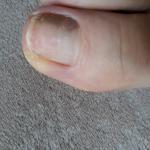 Темное пятно на ногте большого пальца ноги фото 1