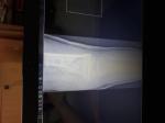 Открытый оскольчатый внутрисуставной перелом бедренной кости фото 5