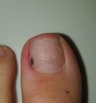 Темно-коричневое пятно на ногте большого пальца фото 2