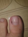 Темно-коричневое пятно на ногте большого пальца фото 1
