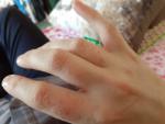 Сыпь на руках, зудит, в основном распространена на пальцах рук фото 3