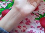 Сыпь на руках, зудит, в основном распространена на пальцах рук фото 5