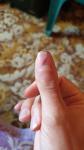 Повреждение ногтевой пластинки фото 1