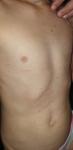 Сыпь на теле у ребенка на спине, животе и груди фото 3