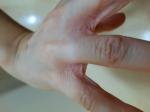 Шелушение между пальцами рук фото 1