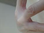 Шелушение между пальцами рук фото 2