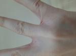 Шелушение между пальцами рук фото 3