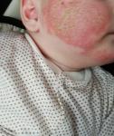 Аллергия на щеках фото 1